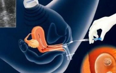 美国第三代试管婴儿技术筛查疾病基因，保证优生优育